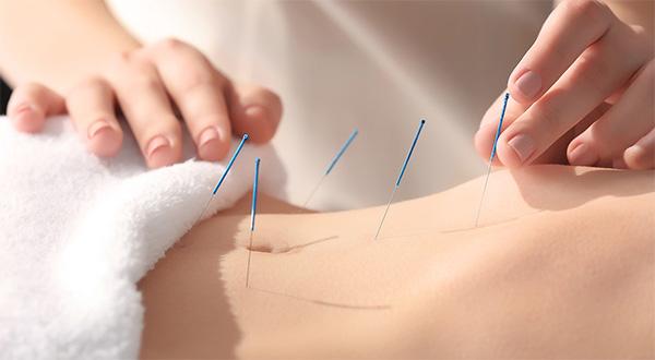 Acupuncture